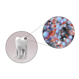 2次カリエスとは？治療後の虫歯を防ぐためのポイントを解説！